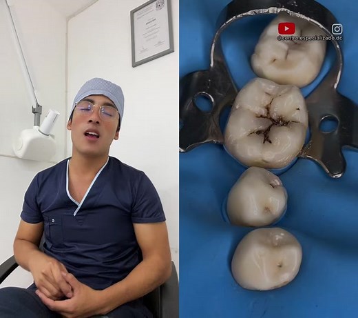 Cómo colocar resinas dentales de forma efectiva