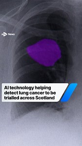 21K views · 122 reactions | AI technology which helps detect lung...