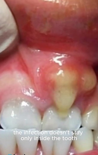 “What Is A Dental Abcess-Find Out!”