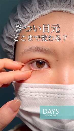【目元整形】きつい目元、どこまで優しくなる？#shorts