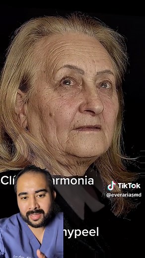 Phenol Peel Procedure: Risks, Benefits, and Results Explained