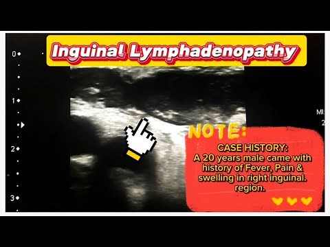 Swollen Lymph Nodes in the Groin || Inguinal Lymphadenopathy || Groin Pain/Fever ||Ultrasound study
