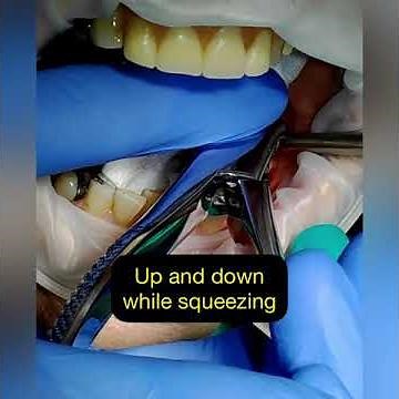 Step by step extraction Mandibular Molar. How to Extract a Tooth