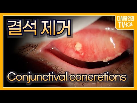 conjunctival concretions. How have you been living with this discomfort?
