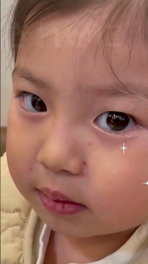 2歳の女児の霰粒腫摘出術の経過‪@marine-eye‬ #霰粒腫 #元町マリン眼科 #ものもらい手術