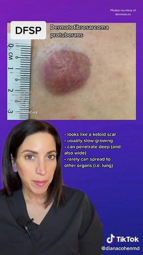 #dfsp #skincancer #keloid #skincancerawareness #dermatologist