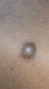 Sebaceous cyst | Dr Khaled's Tumour Helpline