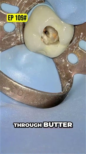 Effortlessly Remove GP Fast Rotary File Technique