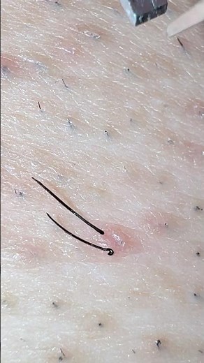 抜きすぎて毛穴が炎症起こしとる❗️💢#毛抜き #毛抜き動画 #plucking #blackheads #埋没毛 #ingrownhair #tweezers #extraction #毛根