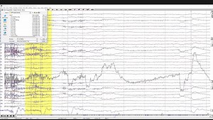 ERP分析（基于BESA软件）