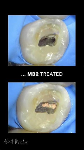 Root canal retreatment with thermafills and missed MB2. One year after complete bone regeneration.