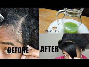 HOME MADE REMEDY FOR DANDRUFF CURE || THIS WILL GET RID OF YOUR DANDRUFF
