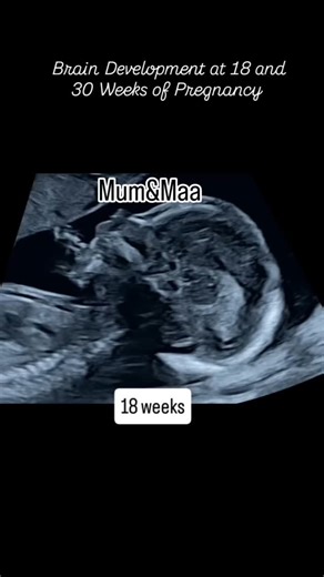 Mum&Maa on Instagram: "🧠 Fetal Brain Color Doppler Scan at 18 Weeks – Circle of Willis Here is point-wise content you can use: --- 1. 🗓 Gestational Age: The scan is taken at 18 weeks, which is a key time for detailed neurosonography. 2. 🧠 What is Visible: The Circle of Willis — a circular network of arteries at the base of the fetal brain. This structure supplies blood to the cerebrum and brainstem. Color Doppler highlights blood flow within the arteries. 3. 📍 Arteries Seen: Likely includes: