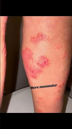 Nummular versus eczema herpeticum