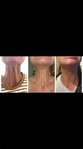 Dr. René Colborne Aesthetics on Instagram: "..💉💦.. #nephrititilift - botulinum toxin injectable to the neck / lower face Book pre-New years eve on 0837726514 ✨ #botox #lipfiller ##ballitoaesthetics"