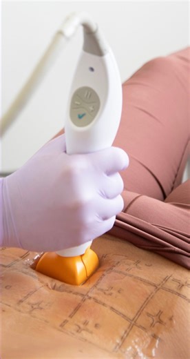 Thermage® FLX is designed with precision in mind, featuring specialized tips tailored for different treatment zones. From full-face tightening to spot treatments on the face or body, each session can be fully customized to your unique goals. It’s all about tightening, smoothing, and treating exactly where you need it most. Visit https://bit.ly/Thermage-FAD to find a Thermage provider near you! Actual patient. Results may vary. Ask your doctor if Thermage is right for you. See thermage.com or the