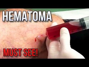 Golden Hematoma! Big Mass in Thigh! NEW CYSTS, POPS & PIMPLES