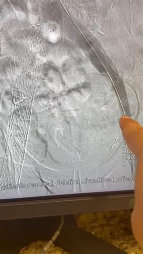 Iliac Vein Stenting: From Severe Blockage to Full Flow | Amazing Transformation