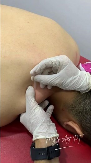 Upper Trapezius Dry Needling
