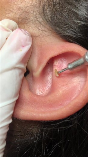 Ear Examination Close-Up: Understanding Ear Care