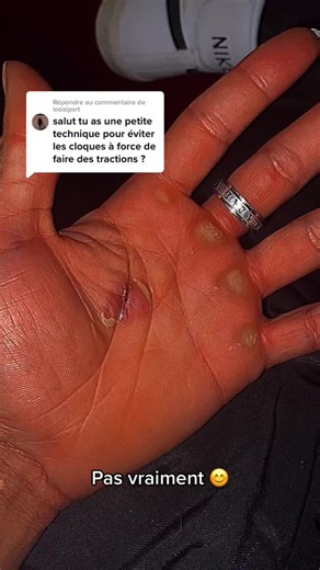 Understanding Hand Injuries and Prevention Techniques