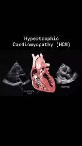 31K views · 312 reactions | Hypertrophic Cardiomyopathy (HCM) is a...