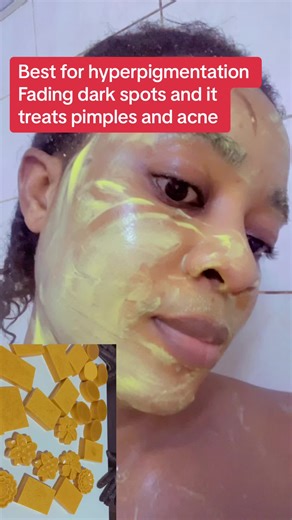 Hyperpigmentation Treatment Soap - Best Solution for Dark Spots and Acne