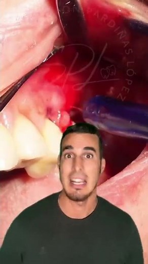 Tremendous INFECTION with PHLEGMON or DENTAL ABSCESS - All this had inside the GUM