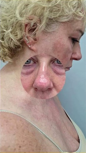 a defined jawline less heaviness under the chin | Dr. Prashant #doublechinlipo