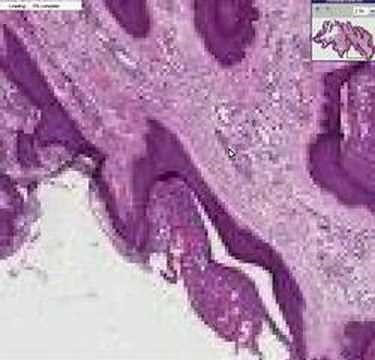 Histopathology Skin--Fibroepithelial polyp (skin tag)