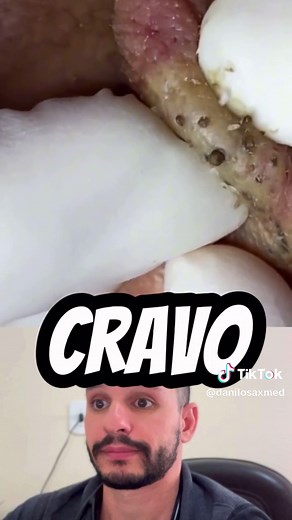 Cravos: O Que São, Como Surgem e Como Tratar