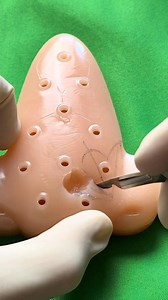 Bilobed flap for nasal reconstruction (part 2) | Dermhacks