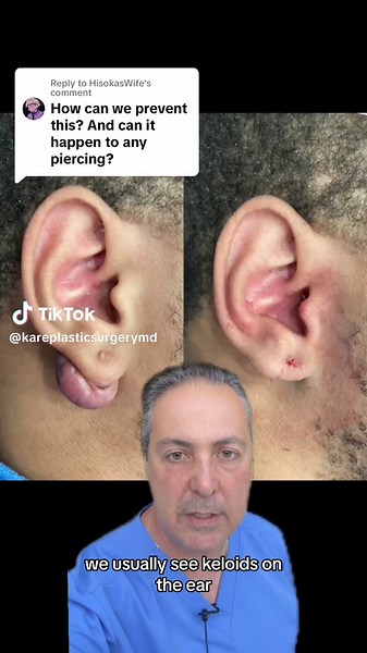 Understanding Keloids: Treatment and Prevention Guide