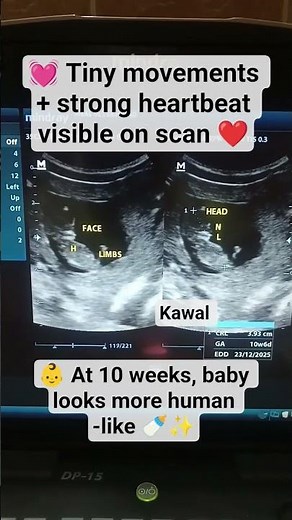🔎 10 Weeks Pregnancy ultrasound |Baby’s First Movements ❤️👶 #ultrasound #baby