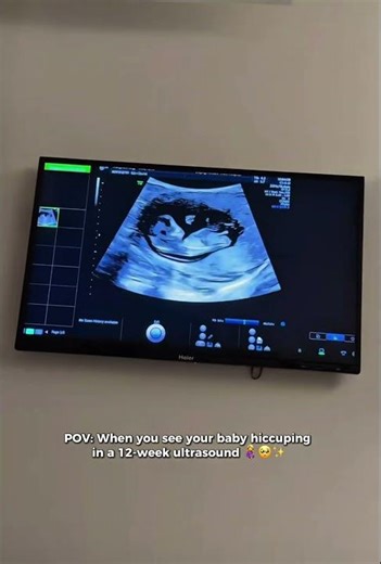 Hiccuping at 12 weeks ultrasound?!😍 Yes, that's our little star! #pregnancy #baby #ultrasound #ivf