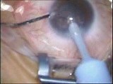 Cataract Surgery - Phacoemulsification • Video • MEDtube.net