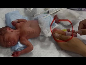 23 Weeks Premature Baby | 0.6kg Micro Preemie | IV Line Insertion & NICU Care #babyrecovery