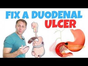 How to Correct a Duodenal Ulcer