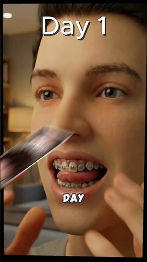 How Braces Move Your Teeth 😬🦷