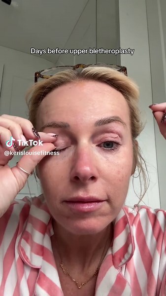 Understanding Upper Blepharoplasty Eyelid Surgery Journey