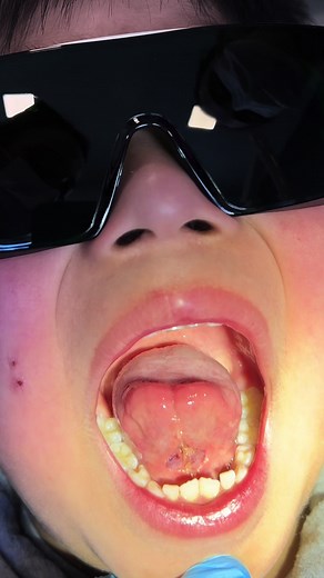 Frenectomía Lingual con Láser: Beneficios y Procedimiento