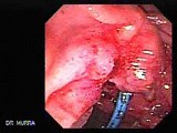Adenocarcinoma of the Vater Papilla - Stent Migration (2 of 7) • Video • MEDtube.net