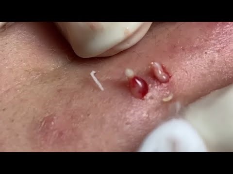 Pus & Blood Explosion! Extreme Blackhead & Pimple Popping Close-Up #acneremove #acneremoval #acne