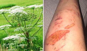 Hogweed: Expert explains dangers of plant