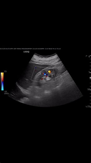 Dr. Siddharth's Imaging & Intervention Centre on Instagram: "USG-guided embolization of a renal artery pseudoaneurysm 👇 Real-time ultrasound helps us spot the pseudoaneurysm, guide the needle with precision, and deliver embolic material right into the sac. The blood flow stops instantly — a minimally invasive, organ-saving treatment done safely under imaging guidance.” #InterventionalRadiology #pseudoaneurysm #imageguidedtherapy #clinicalexcellence #minimallyinvasive"