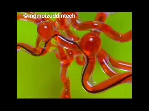 Robotic thread , advance tecnology , blood clots ka ilaj ab aur be Aasaan