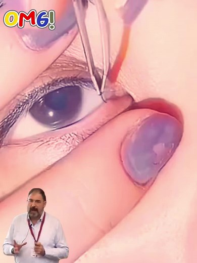 #pillimultigrmini #compoundhair #beardplucking #pluckinggasmr #satisfyingvideos #thickhairpulls #ingownhairremoval #herpangina #faringitis #conultamedica #doctorexplains #medici #herpangina