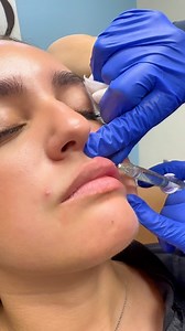 Let’s inject 1 full syringe of Juvederm Ultra/Plus with lip flip💉😍 • • • 📍EL PASO COSMETIC SURGERY ☎️(915)351-1116 (call or text) to schedule your consultation today! #injectables #medspa #facials #lasers #medicalaesthetician #nurseinjector #elpaso #texas #explorepage #explore | El Paso Cosmetic Surgery