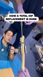 How hip replacement surgery works