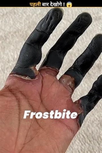 Frostbite 🥶 #facts #shorts